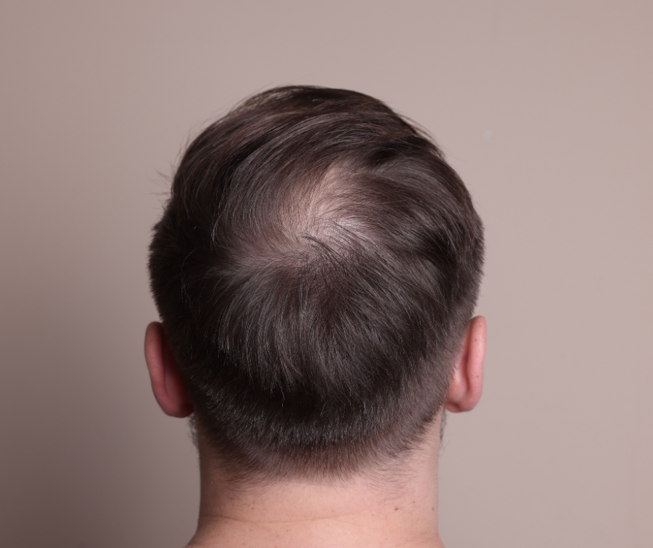 alt leczenie łysienia