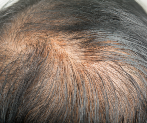 alt leczenie łysienia