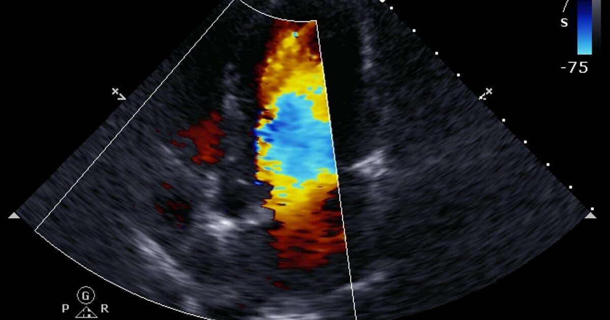 alt USG Doppler